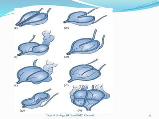 29
Dept of Urology, GRH and KMC, Chennai.
 