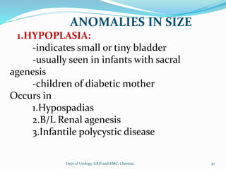 ANOMALIES IN SIZE
1.HYPOPLASIA:
-indicates small or tiny bladder
-usually seen in infants with sacral
agenesis
-children of diabetic mother
Occurs in
1.Hypospadias
2.B/L Renal agenesis
3.Infantile polycystic disease
30
Dept of Urology, GRH and KMC, Chennai.
 