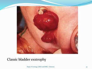 Classic bladder exstrophy
43
Dept of Urology, GRH and KMC, Chennai.
 
