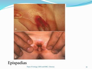 Epispadias
49
Dept of Urology, GRH and KMC, Chennai.
 