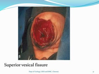 Superior vesical fissure
51
Dept of Urology, GRH and KMC, Chennai.
 