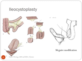 Bladder carcinoma- augmentation cystoplasty complications | PDF