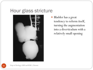 Bladder carcinoma- augmentation cystoplasty complications | PDF