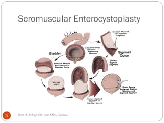 Bladder carcinoma- augmentation cystoplasty complications | PDF