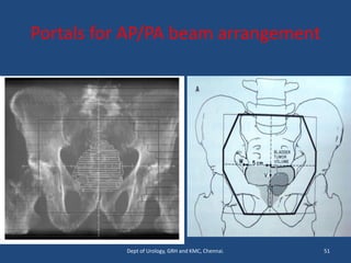 Portals for AP/PA beam arrangement
51
Dept of Urology, GRH and KMC, Chennai.
 
