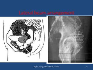 Lateral beam arrangement
53
Dept of Urology, GRH and KMC, Chennai.
 