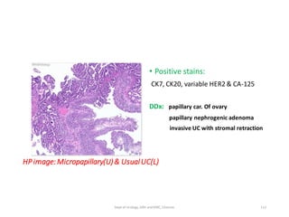 HP image:Micropapillary(U)& UsualUC(L)
• Positive stains:
CK7, CK20, variable HER2 & CA-125
DDx: papillary car. Of ovary
papillary nephrogenic adenoma
invasive UC with stromal retraction
112
Dept of Urology, GRH and KMC, Chennai.
 