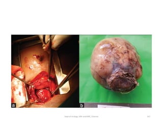 147
Dept of Urology, GRH and KMC, Chennai.
 