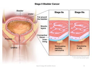 EPIDEMIOLOGY
• 9th most common cancer world wide
• Cancer of environment and advancing age
• Peak Incidence - 8th decade of life
• Strong association with environmental
toxins
41
Dept of Urology, GRH and KMC, Chennai.
 