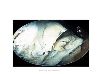 54
Dept of Urology, GRH and KMC, Chennai.
 