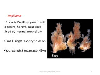 Papilloma
• Discrete Papillary growth with
a central fibrovascular core
lined by normal urothelium
• Small, single, exophytic lesion
• Younger pts ( mean age- 46yrs)
64
Dept of Urology, GRH and KMC, Chennai.
 