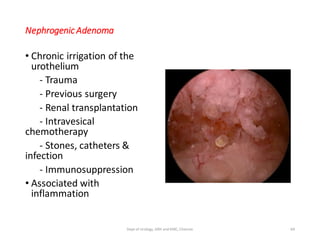 Nephrogenic Adenoma
• Chronic irrigation of the
urothelium
- Trauma
- Previous surgery
- Renal transplantation
- Intravesical
chemotherapy
- Stones, catheters &
infection
- Immunosuppression
• Associated with
inflammation
69
Dept of Urology, GRH and KMC, Chennai.
 