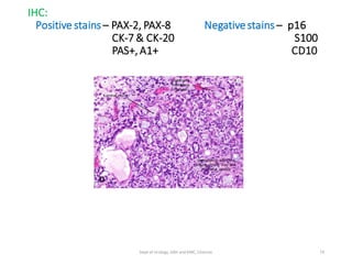 IHC:
Positive stains – PAX-2, PAX-8 Negativestains – p16
CK-7 & CK-20 S100
PAS+, A1+ CD10
74
Dept of Urology, GRH and KMC, Chennai.
 