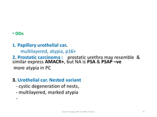 • DDx
1. Papillary urothelial car.
multilayered, atypia, p16+
2. Prostatic carcinoma : prostatic urethra may resemble &
similar express AMACR+, but NA is PSA & PSAP –ve
more atypia in PC
3. Urothelial car. Nested variant
- cystic degeneration of nests,
- multilayered, marked atypia
-
75
Dept of Urology, GRH and KMC, Chennai.
 