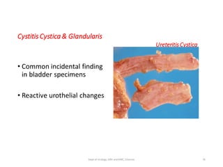 Cystitis Cystica & Glandularis
UreteritisCystica
• Common incidental finding
in bladder specimens
• Reactive urothelial changes
76
Dept of Urology, GRH and KMC, Chennai.
 