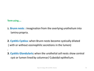 Term using....
1. Brunn nests : invagination from the overlying urothelium into
lamina propria.
2. Cystitis Cystica: when Brunn nests become cystically dilated
( with or without eosinophilic secretions in the lumen)
.
3. Cystitis Glandularis: when the urothelial cell nests show central
cyst or lumen lined by columnar/ Cuboidal epithelium.
78
Dept of Urology, GRH and KMC, Chennai.
 