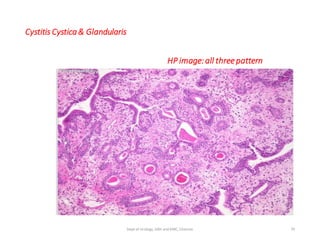 Cystitis Cystica& Glandularis
HP image:all threepattern
79
Dept of Urology, GRH and KMC, Chennai.
 
