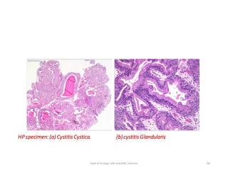 HPspecimen: (a)CystitisCystica. (b)cystitis Glandularis
80
Dept of Urology, GRH and KMC, Chennai.
 