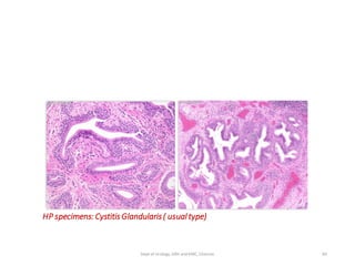 HP specimens: CystitisGlandularis( usualtype)
85
Dept of Urology, GRH and KMC, Chennai.
 