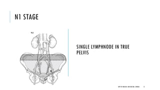 N1 STAGE
SINGLE LYMPHNODE IN TRUE
PELVIS
12
DEPT OF UROLOGY, GRH AND KMC, CHENNAI.
 