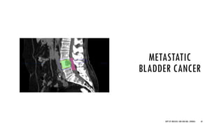 METASTATIC
BLADDER CANCER
64
DEPT OF UROLOGY, GRH AND KMC, CHENNAI.
 