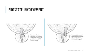 PROSTATE INVOLVEMENT
9
DEPT OF UROLOGY, GRH AND KMC, CHENNAI.
 
