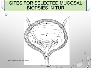 Non muscle invasive bladder carcinoma - management | PDF