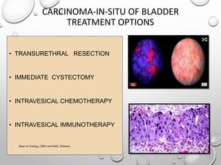 Non muscle invasive bladder carcinoma - management | PDF