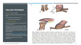 Use of Intestinal segments in urinary diversion | PDF