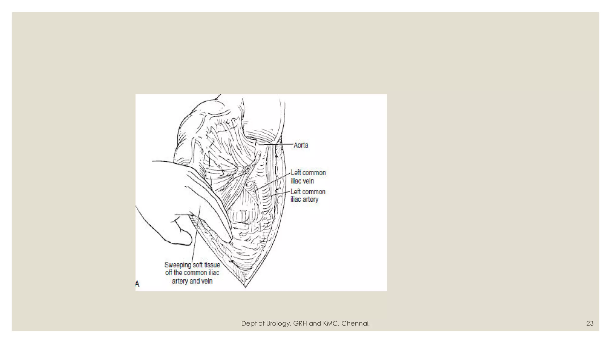 Radical cystectomy | PDF