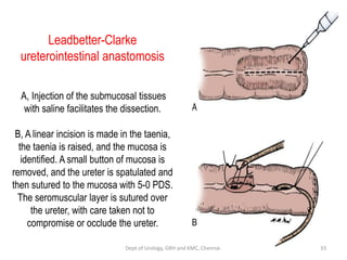 Bladder carcinoma- surgery- substitution | PDF