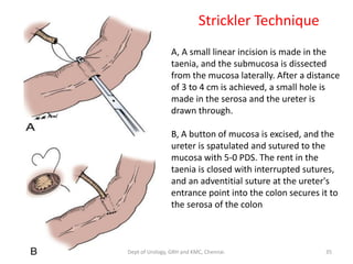Bladder carcinoma- surgery- substitution | PDF