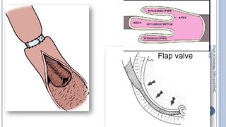 Bladder carcinoma- surgery- urinary diversion | PDF