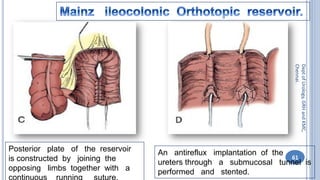 Bladder carcinoma- surgery- urinary diversion | PDF
