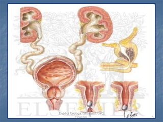 Bladder outlet obstruction | PDF