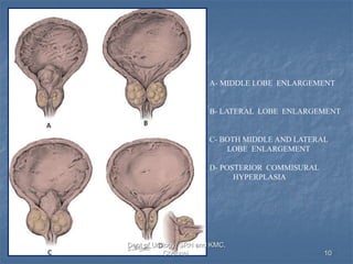 Bladder outlet obstruction