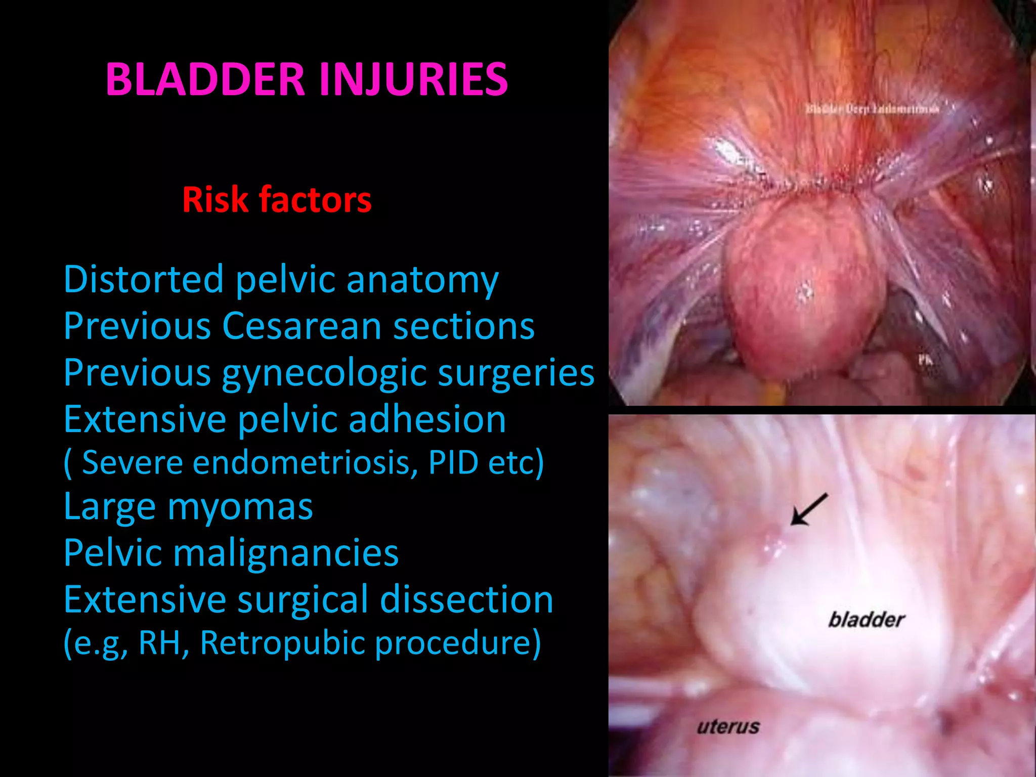 BLADDER INJURIES

       Risk factors
Distorted pelvic anatomy
Previous Cesarean sections
Previous gynecologic surgeries
Extensive pelvic adhesion
( Severe endometriosis, PID etc)
Large myomas
Pelvic malignancies
Extensive surgical dissection
(e.g, RH, Retropubic procedure)
 