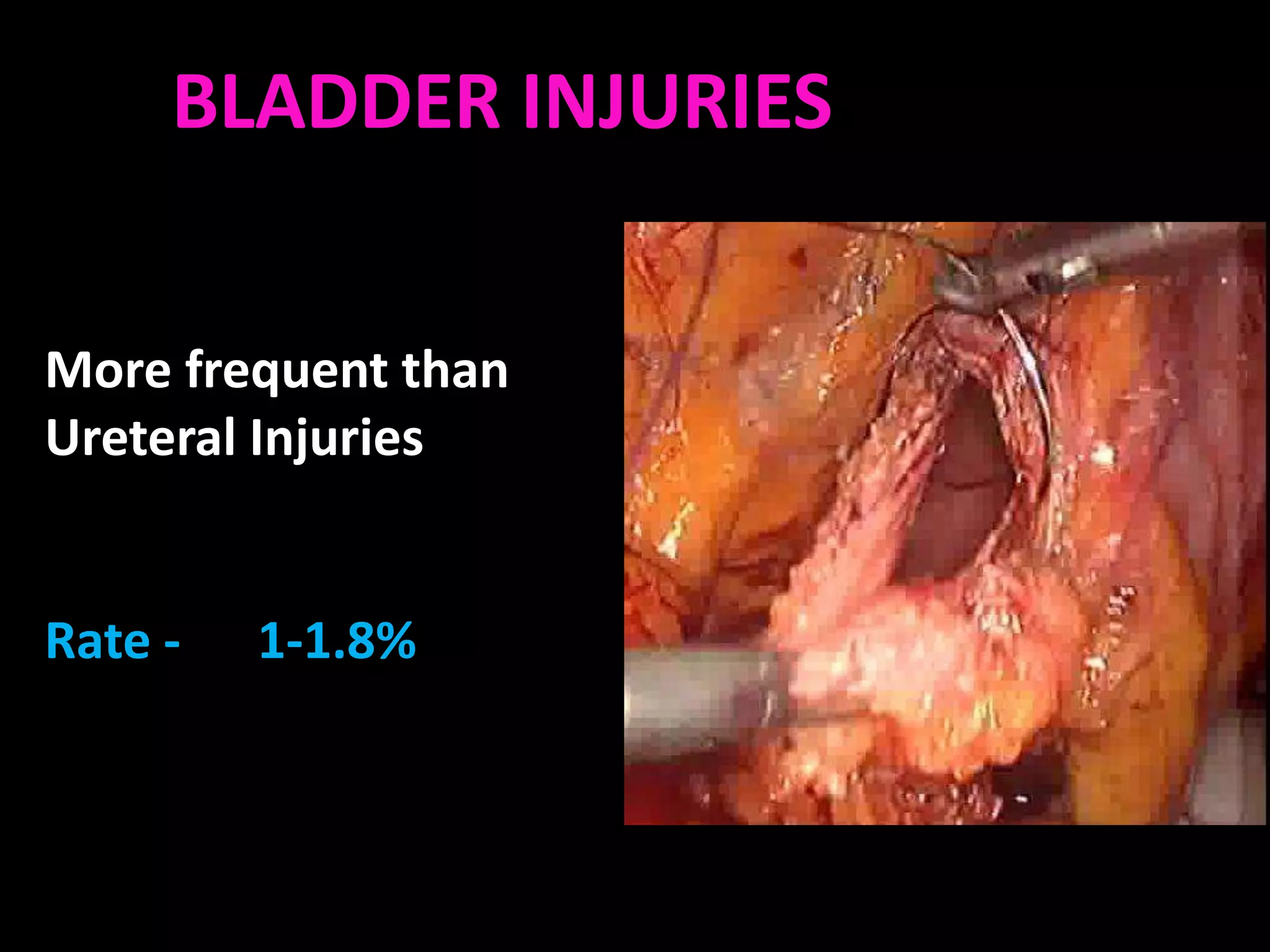 BLADDER INJURIESINJURY
              BLADDER


More frequent than
Ureteral Injuries


Rate -   1-1.8%
 