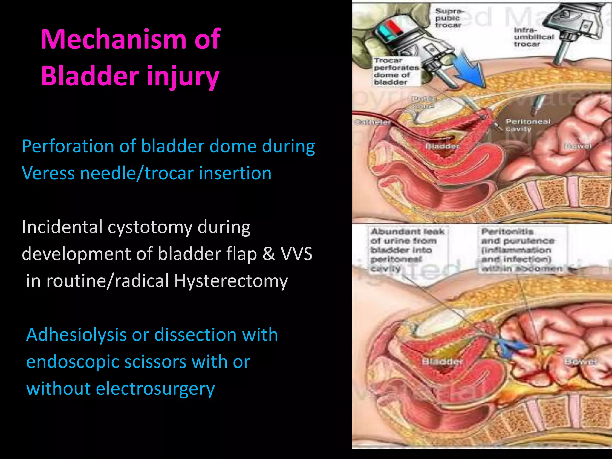 Mechanism of
  Bladder injury

Perforation of bladder dome during
Veress needle/trocar insertion

Incidental cystotomy during
development of bladder flap & VVS
 in routine/radical Hysterectomy

Adhesiolysis or dissection with
endoscopic scissors with or
without electrosurgery
 