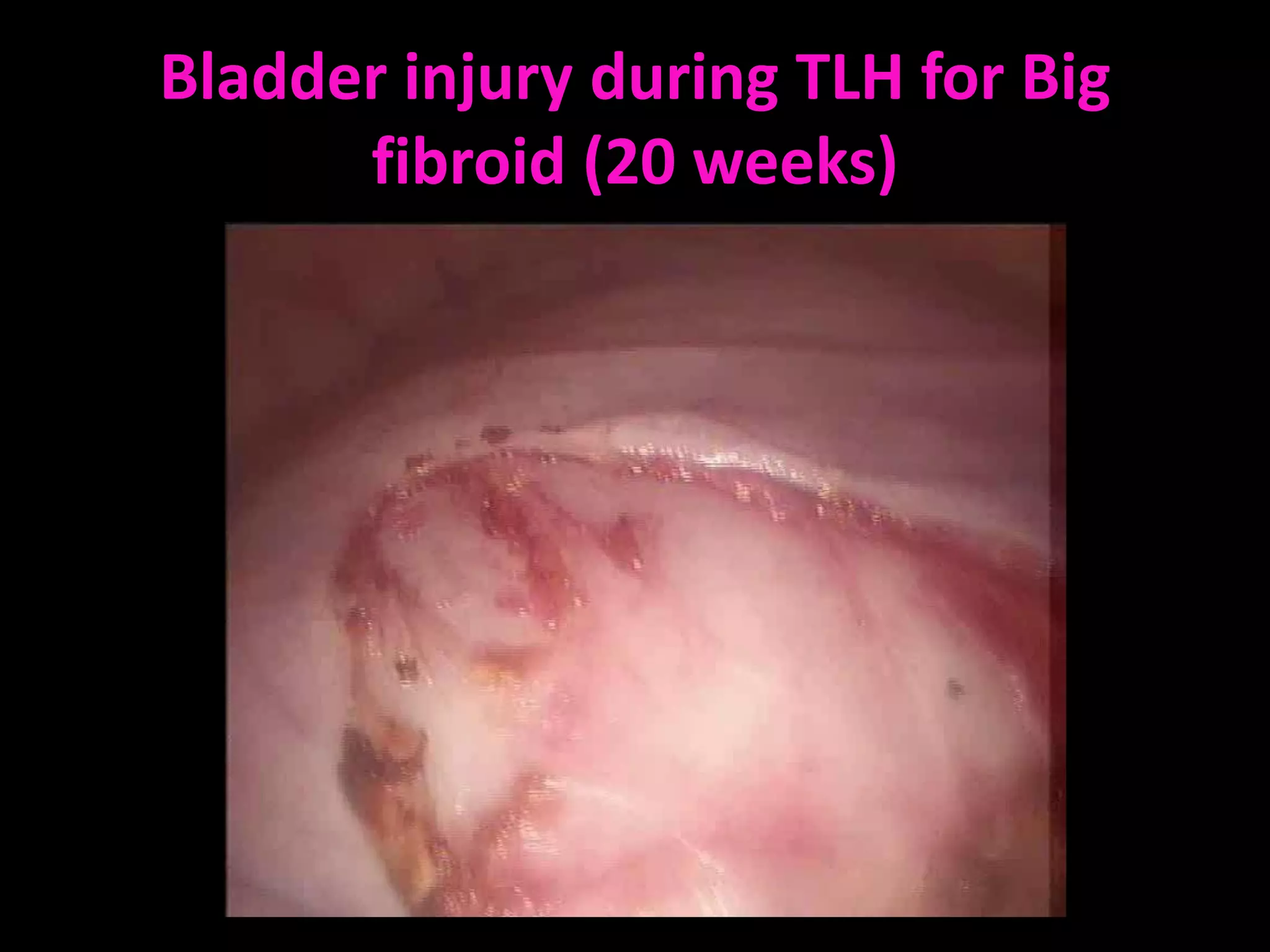 Bladder injury during TLH for Big
      fibroid (20 weeks)
 