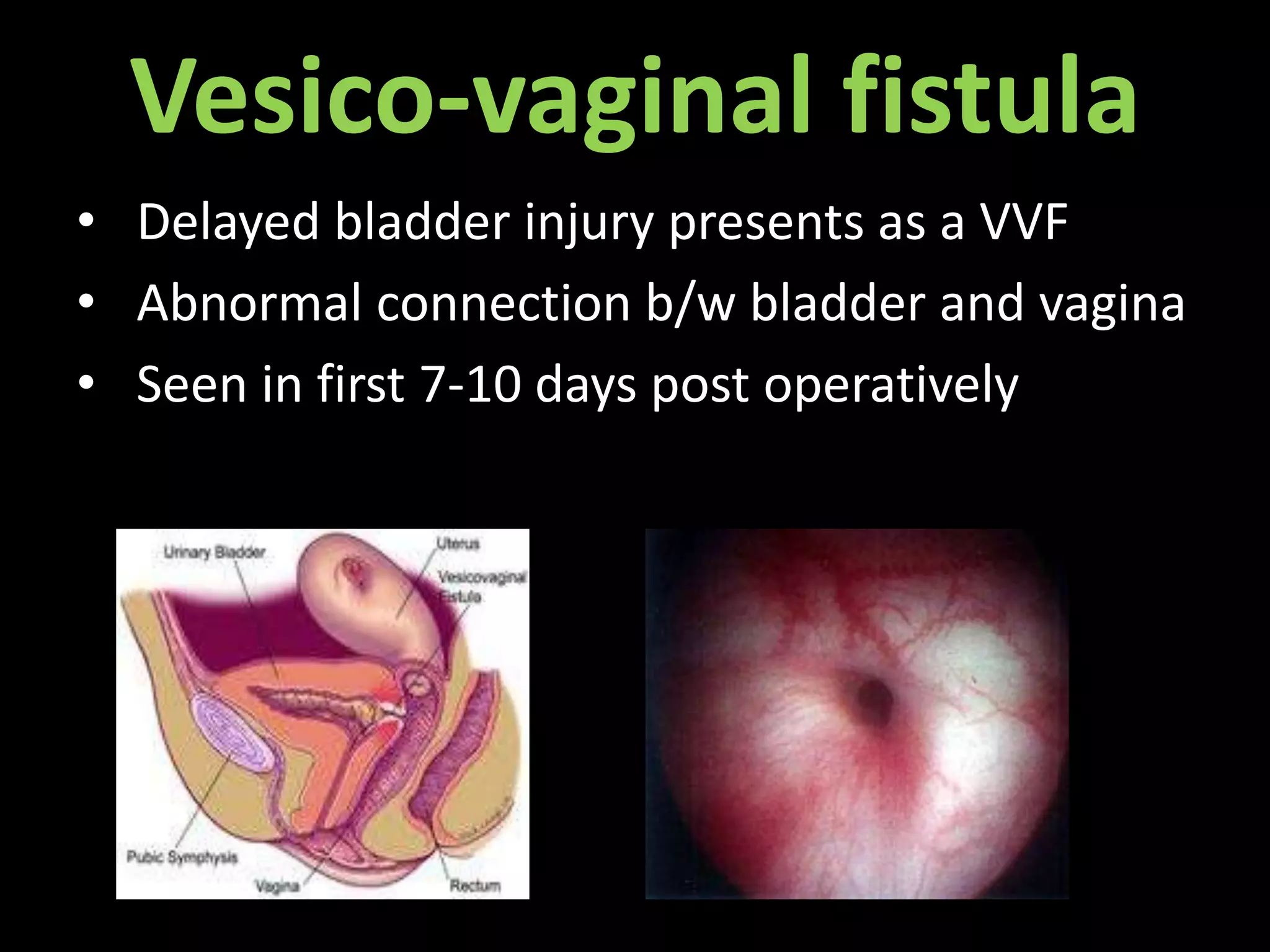 Vesico-vaginal fistula
• Delayed bladder injury presents as a VVF
• Abnormal connection b/w bladder and vagina
• Seen in first 7-10 days post operatively
 