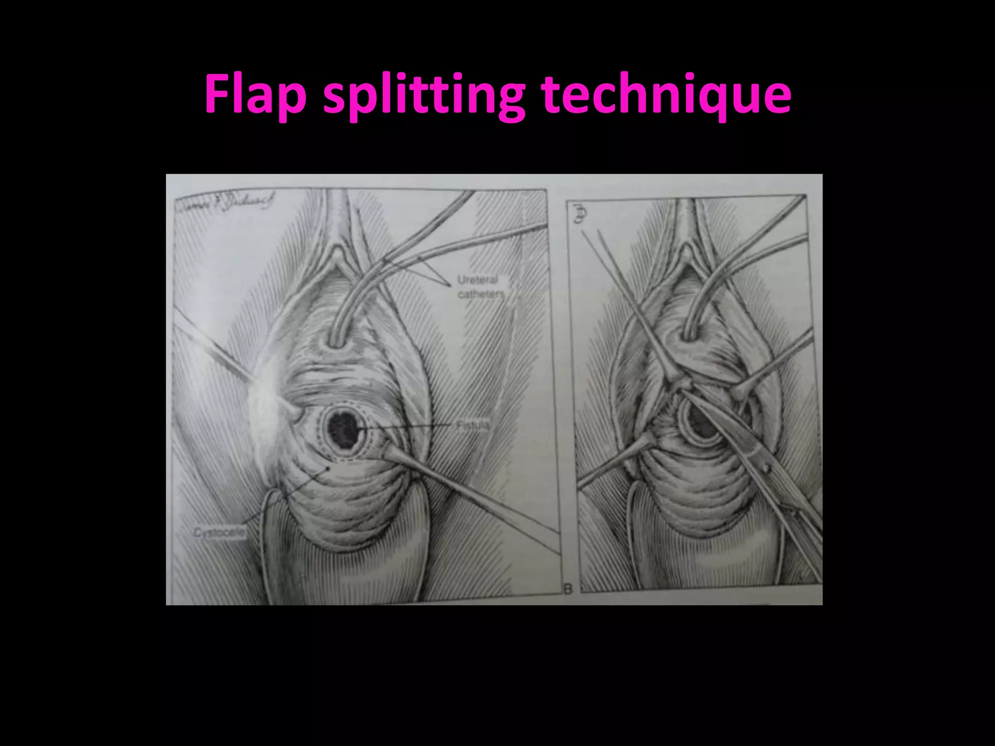 Flap splitting technique
 