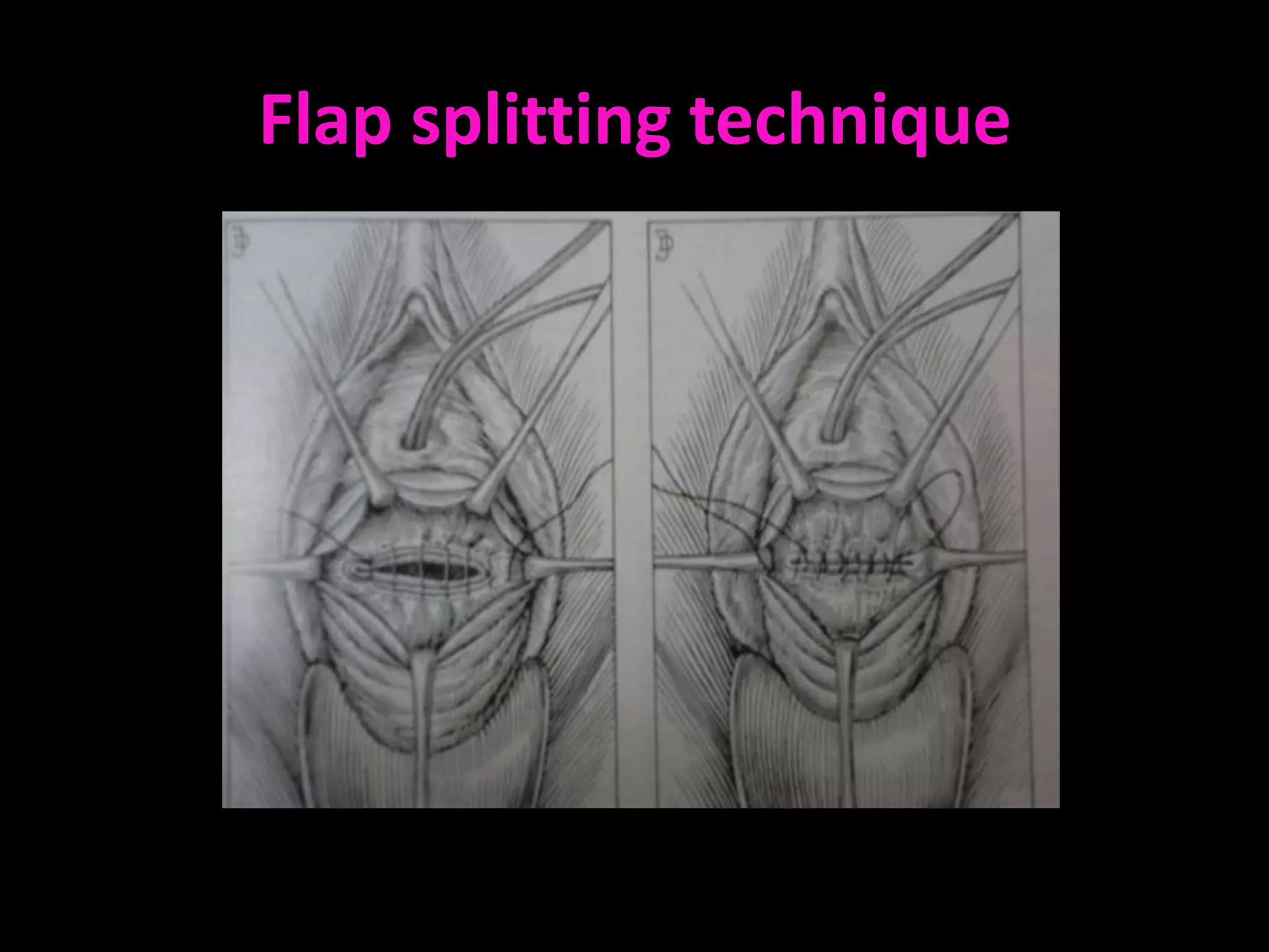 Flap splitting technique
 