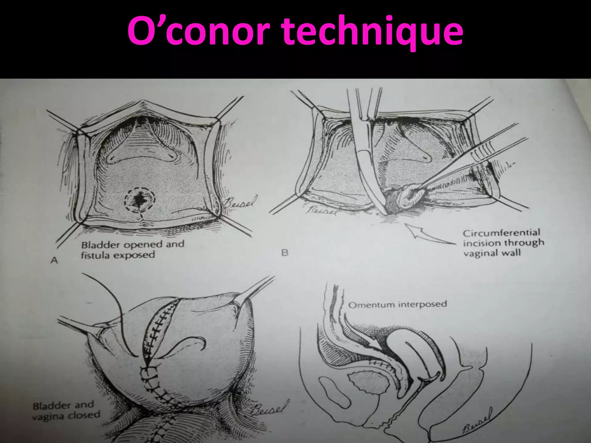 O’conor technique
 