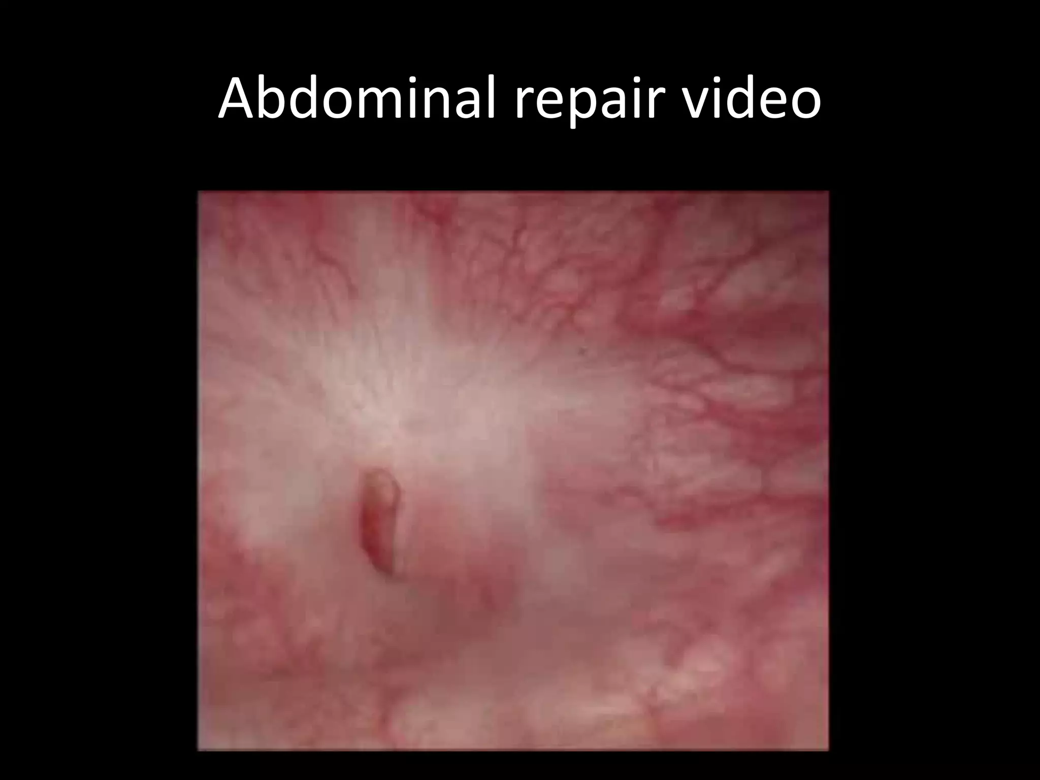 Abdominal repair video
 