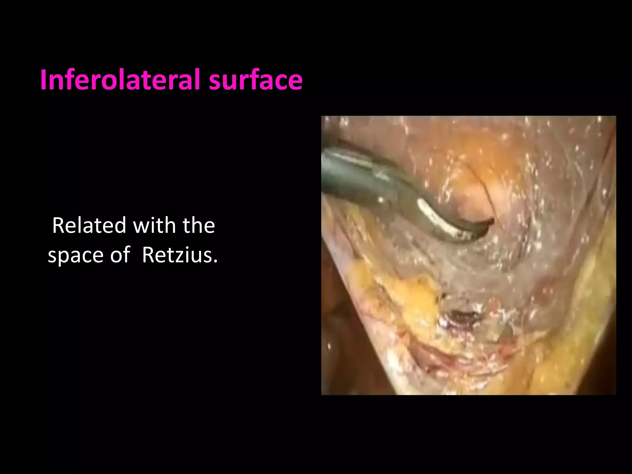 Inferolateral surface



Related with the
space of Retzius.
 