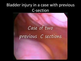 Bladder injury in a case with previous
              C-section
 