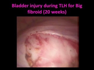 Bladder injury during TLH for Big
      fibroid (20 weeks)
 