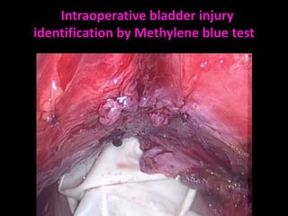 Intraoperative bladder injury
identification by Methylene blue test
 