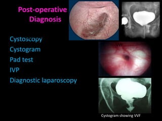 Post-operative
     Diagnosis

Cystoscopy
     POST-OPERATIVE
                                VVF
Cystogram
Pad test
IVP
Diagnostic laparoscopy



                         Cystogram showing VVF
 